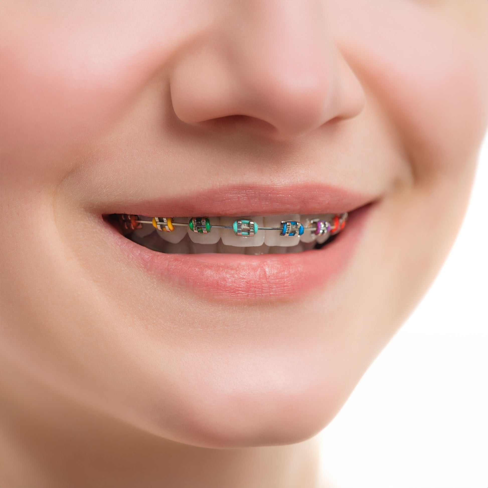 Smiling teen with trendy orthodontic elastics