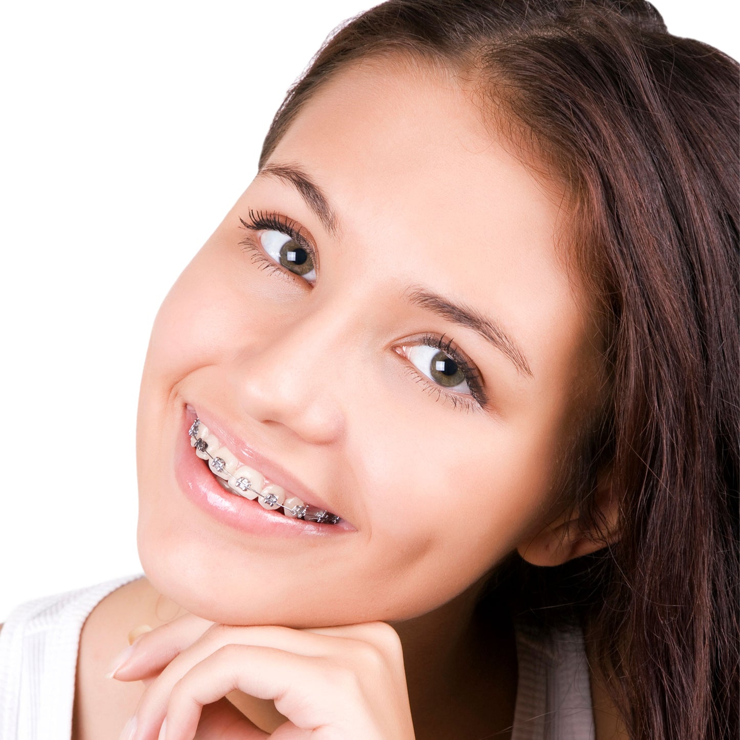 Young lady smiling in Lucchesi sub slot brackets orthodontic braces