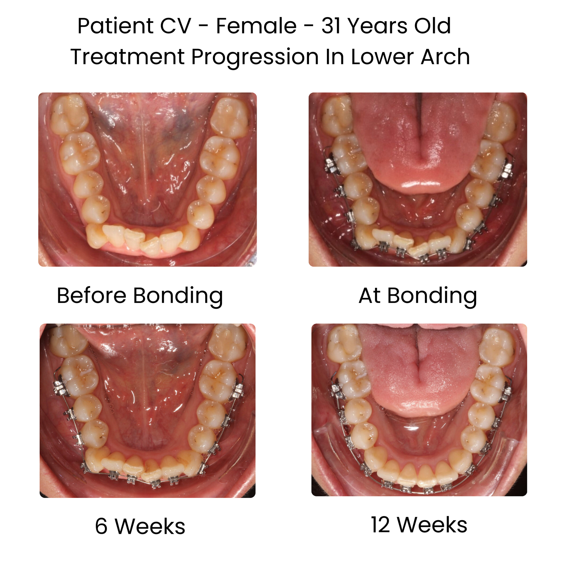 Case Study Lucchesi sub slot brackets lower arch treatment progression