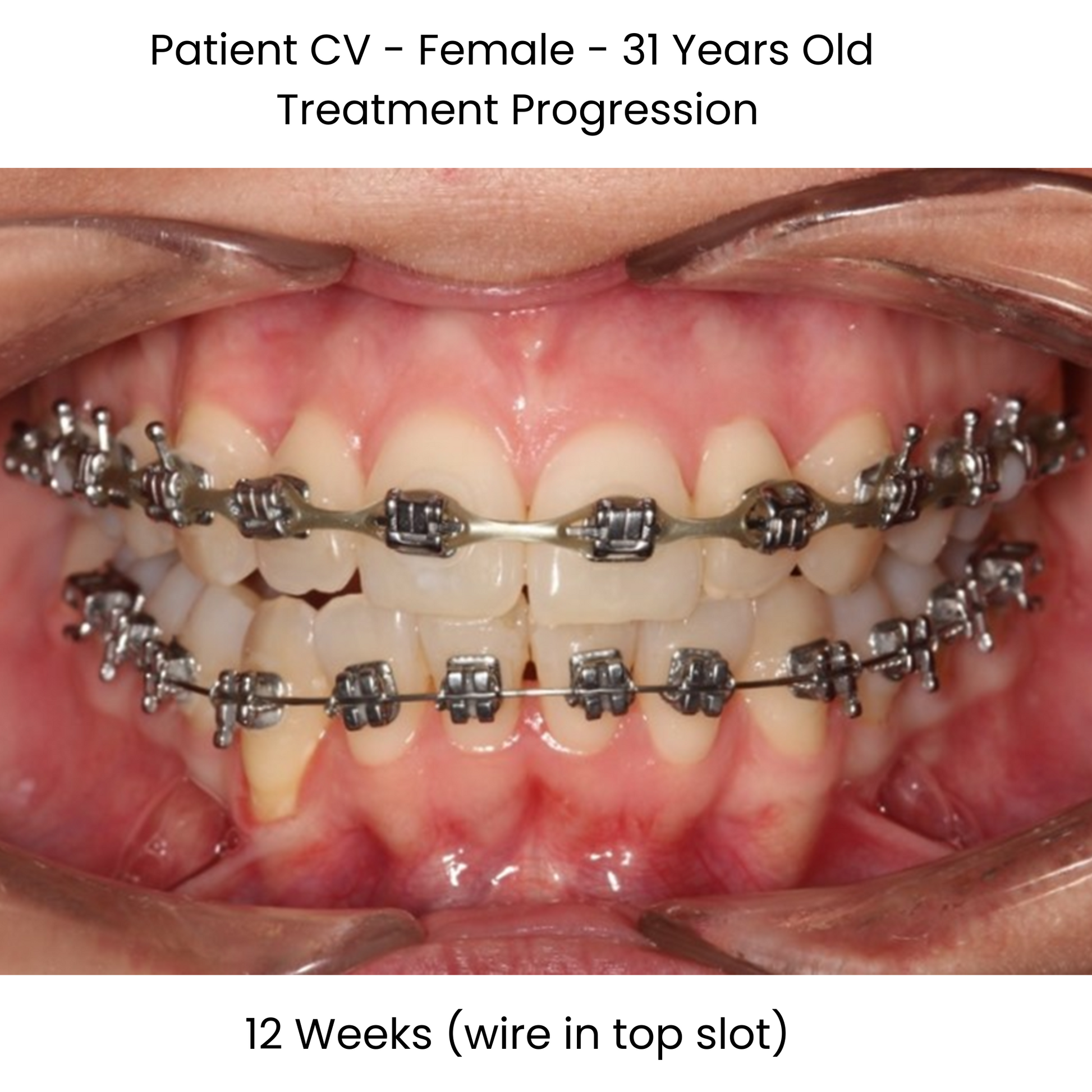 Case Study Lucchesi sub slot brackets 12 weeks with wire in top slot front view