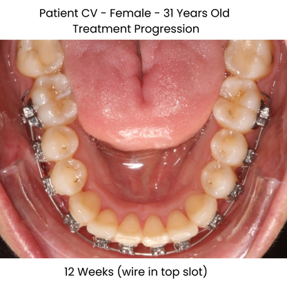 Case Study Lucchesi sub slot brackets 12 weeks with wire in top slot occlusal view