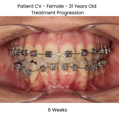 Case Study Lucchesi sub slot brackets 6 weeks front view