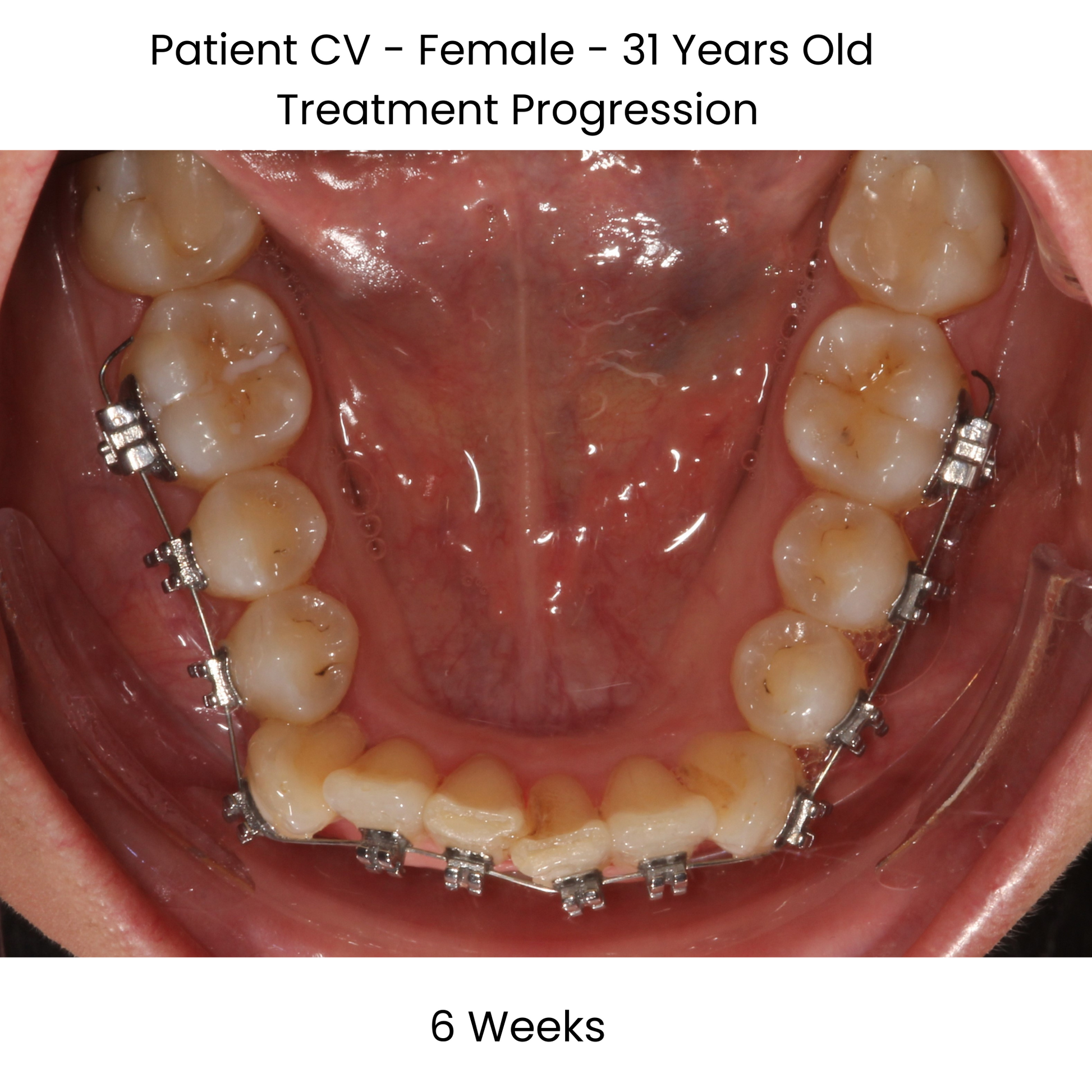 Case Study Lucchesi sub slot brackets 6 weeks occlusal view