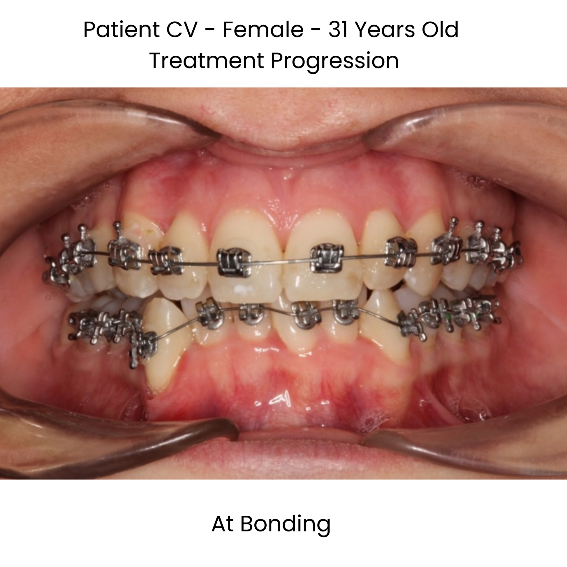 Case Study Lucchesi sub slot brackets at bonding front view