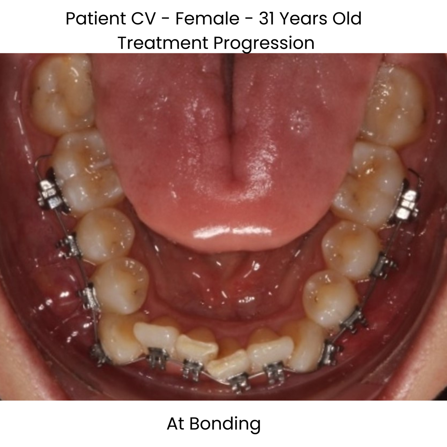 Case Study Lucchesi sub slot brackets at bonding occlusal view