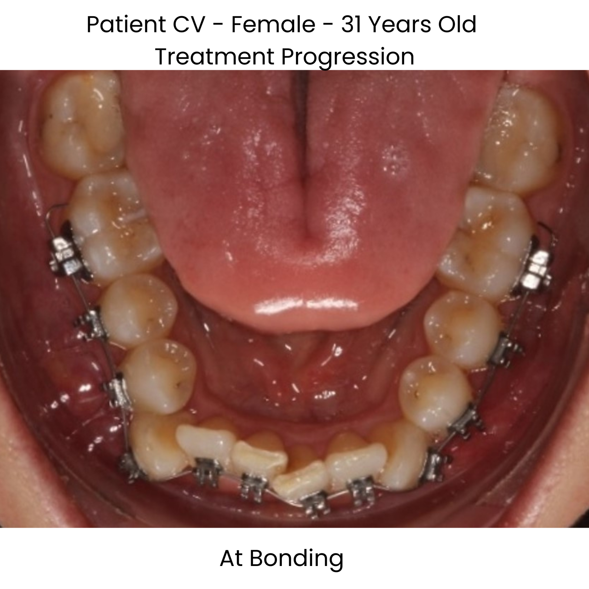 Case Study Lucchesi sub slot brackets at bonding occlusal view