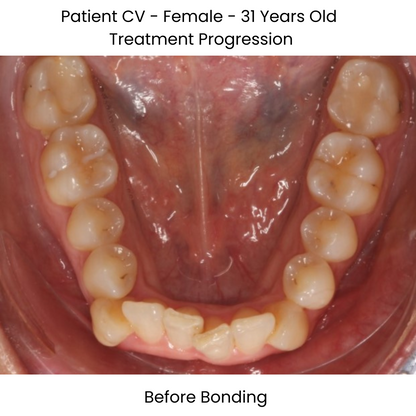 Case Study Lucchesi sub slot brackets before bonding occlusal view